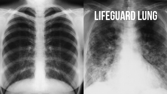 X-ray images of healthy lungs compared to scarred lungs from endemic granulomatous pneumonitis, aka lifeguard lung. Chloramine poisoning.
